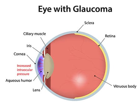 Eye With Glaucoma Diagram