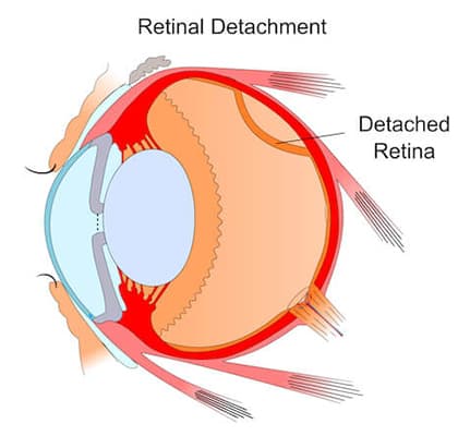 Retinal Detachment Diagram