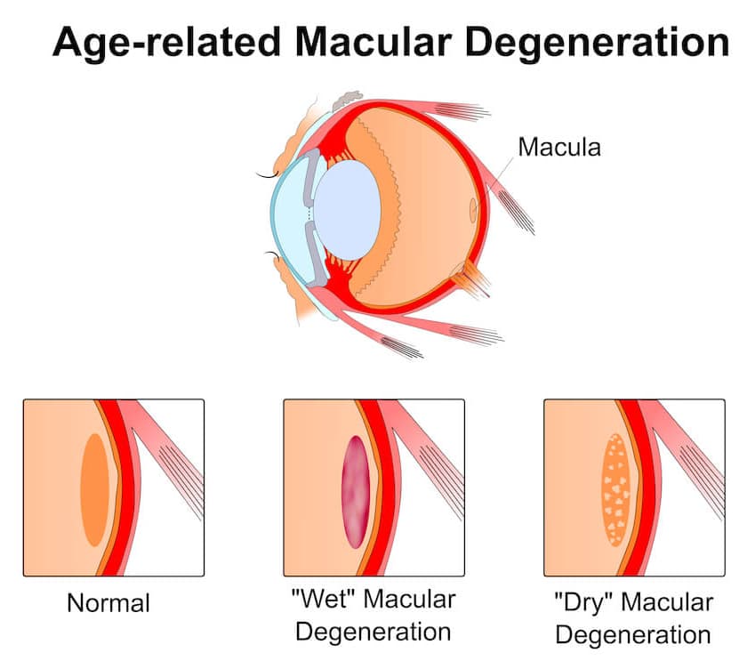 Age Related Macular Degeneration Diagram